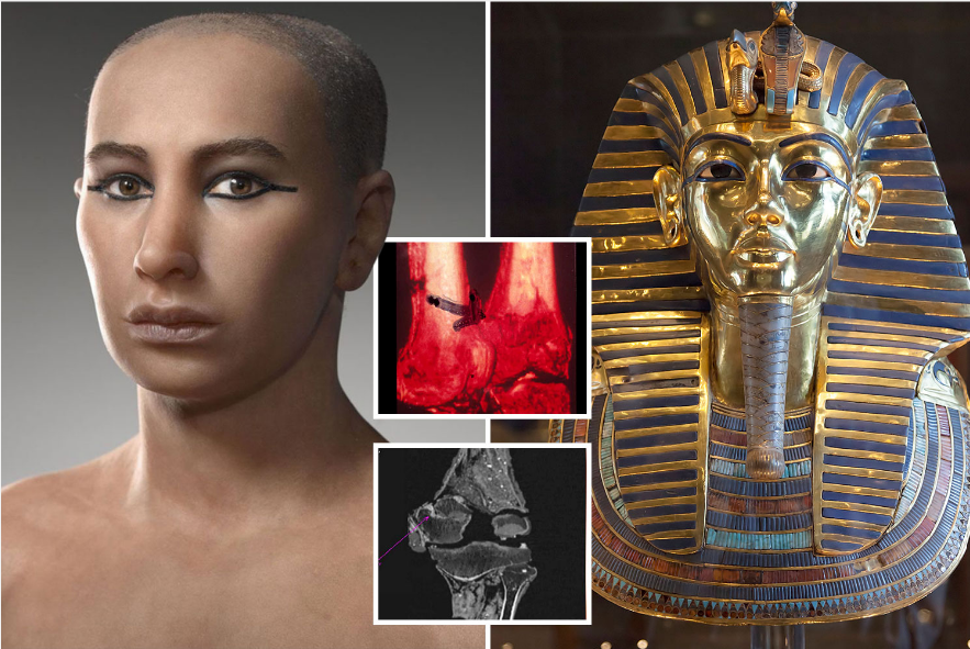 Bukti penyebab kematian Raja Tutankhamun.