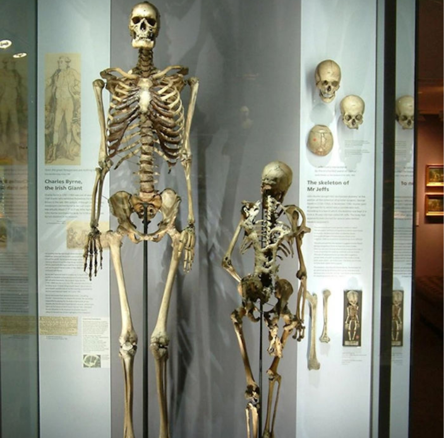 Kerangka Charles Byrne, seorang pria tinggi dari Irlandia, tidak akan dipamerkan di Museum Hunterian di London, Inggris.