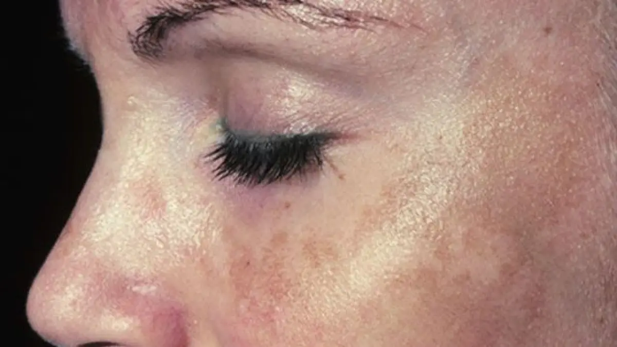 Adanya melasma di wajah disebabkan karena hormon, genetik, dan sinar UV.
