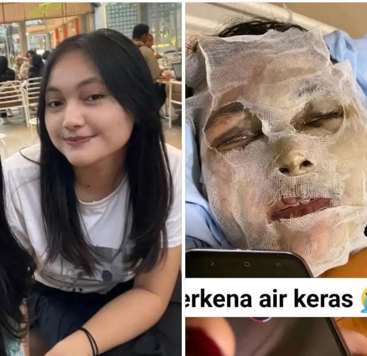 Natasya Hutagalung (21), mahasiswi Sekolah Tinggi Pemerintahan Masyarakat Desa (STPMD) APMD, mengalami luka bakar.