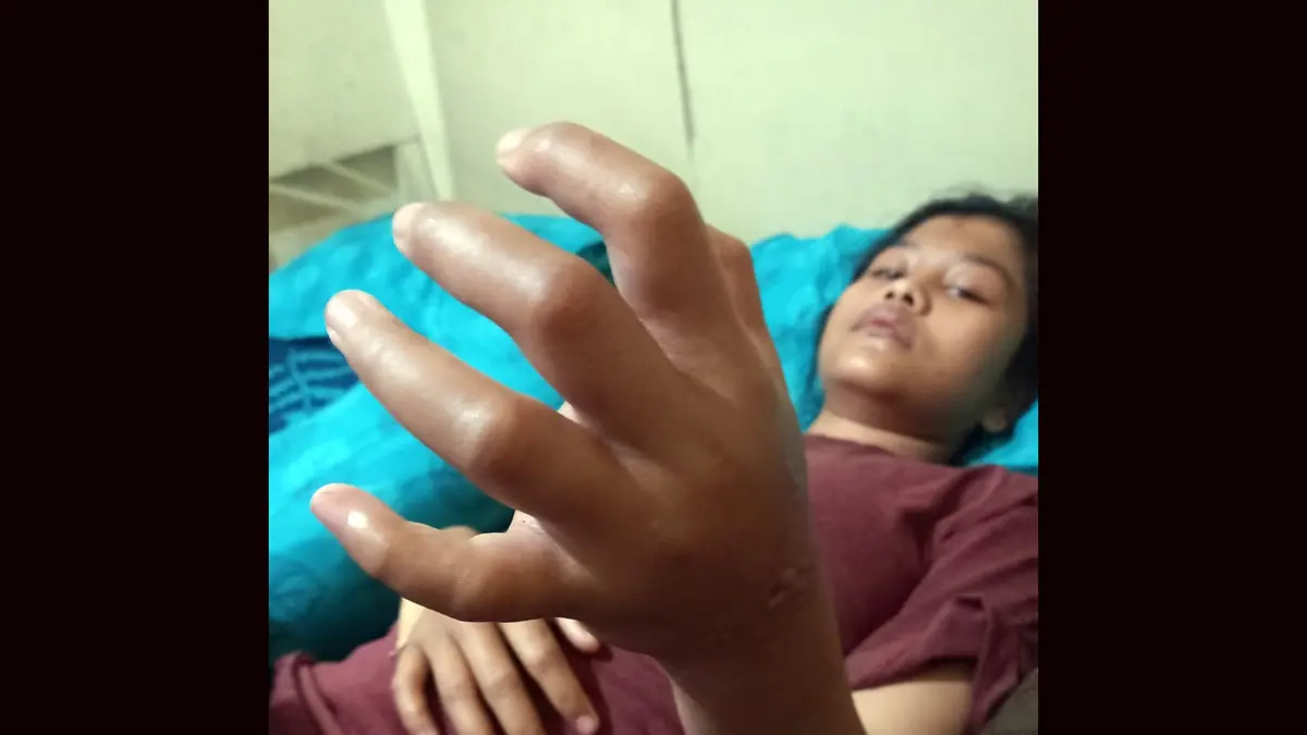 Kondisi tangan kiri pasien RSH yang mengalami pembengkakan usai menjalani perawatan di RS Permata Madina sebelum akhirnya diamputasi.