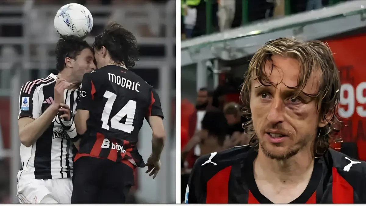 Luka Modric mengalami benturan keras dengan Manuel Locatelli dalam laga AC Milan vs Juventus yang menyebabkan retak tulang pipi dan harus menjalani operasi.