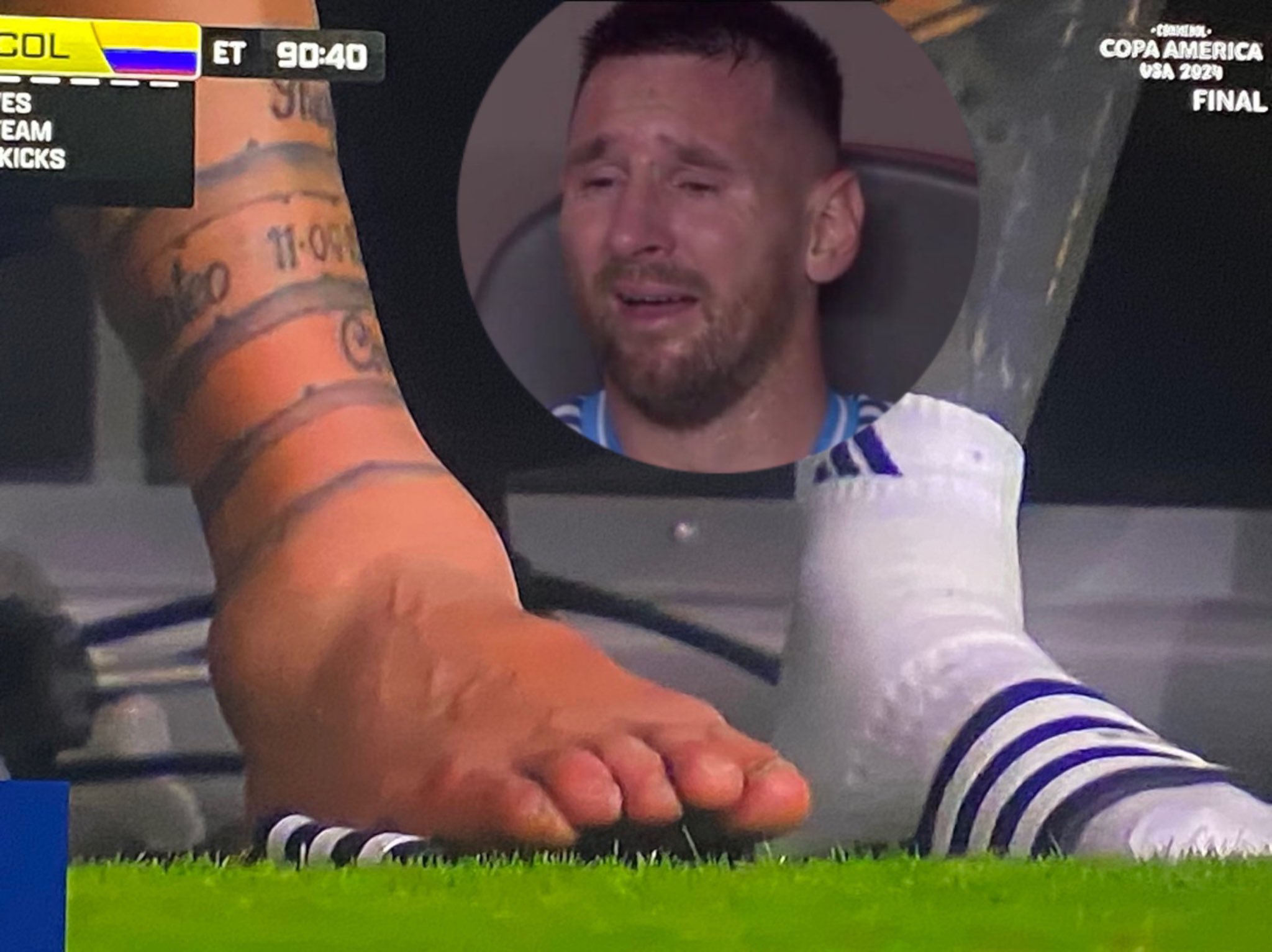 CEDERA PARAH: Engkel kanan Lionel Messi yang bengkak tertangkap kamera.