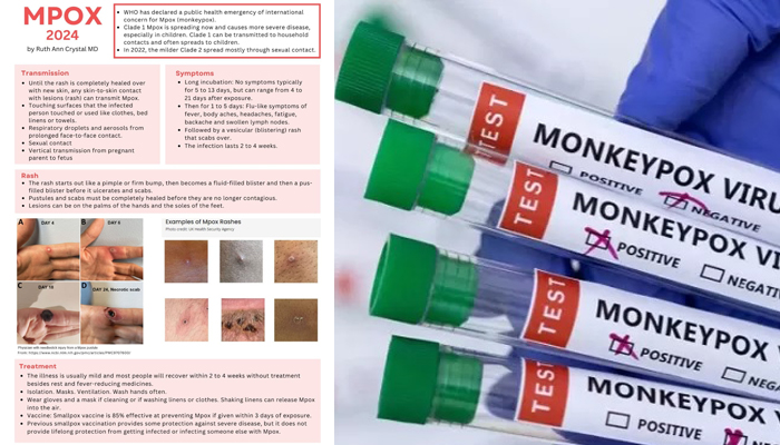 Meskipun Mpox menimbulkan kekhawatiran, tidak ada alasan untuk menyamakannya dengan pandemi virus corona.