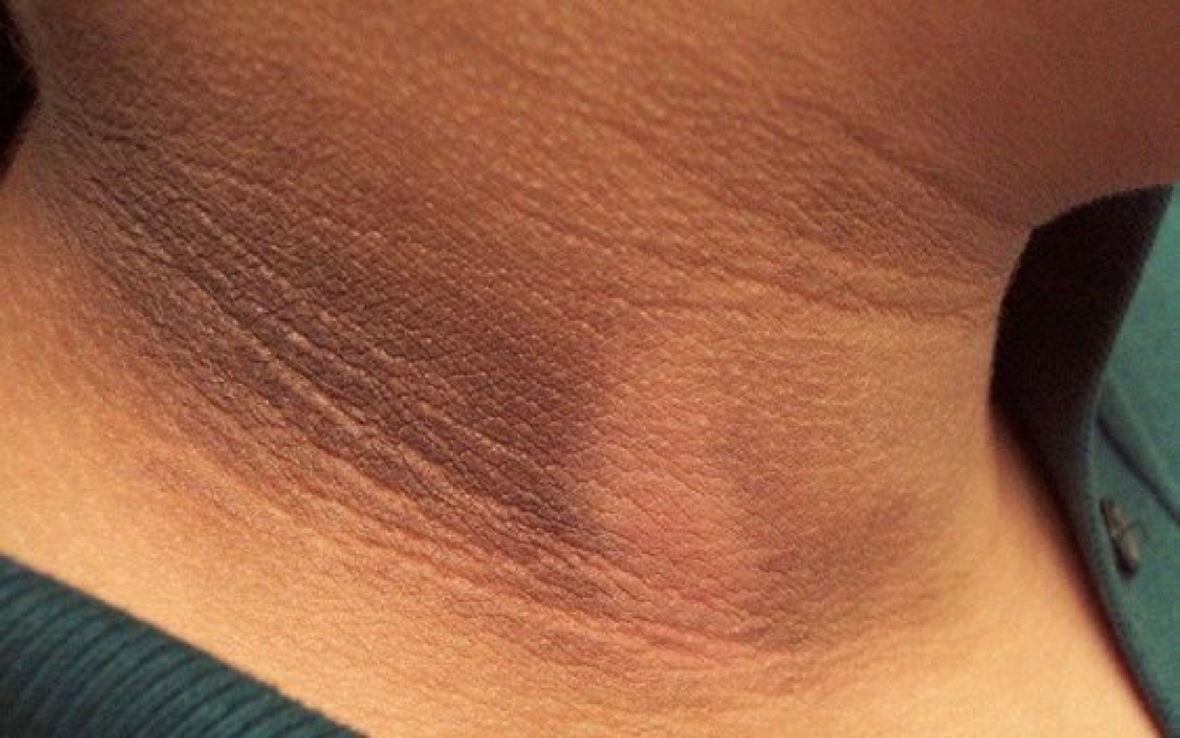 Leher hitam bisa menjadi tanda awal penyakit kronis sehingga harus diwaspadai sejak dini. (Foto: Fabbon)