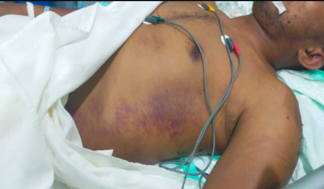 Kondisi tubuh Prada Lucky Namo saat dirawat di RSUD Aeramo, Nagekeo, NTT. Terlihat jelas luka lebam di bagian dada, memicu dugaan kuat terjadi kekerasan fisik sebelum korban meninggal dunia. (FOTO: IS