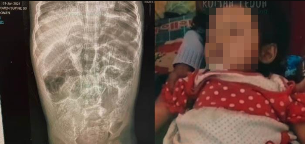 Hasil CT scan memperlihatkan kondisi Raya (3), balita asal Kampung Padangenyang, Desa Cianaga, Kabandungan, Sukabumi, yang meninggal Juli 2025. (Instagram @rumah_teduh_sahabat_iin)
