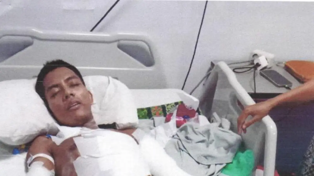 KECELAKAAN KERJA: Nasib ​Ramdoni yang didiagnosis menderita luka bakar grade 2 dengan area luka mencapai 59 persen dari total permukaan tubuh. Ia tersiram bubur panas saat bekerja di warung makan pada April lalu. IST/KP