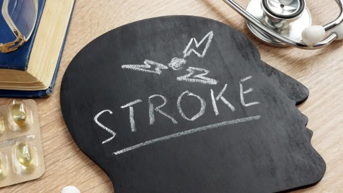 Ilustrasi stroke.(getty images)