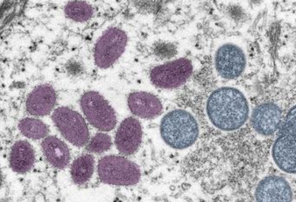 Mpox adalah infeksi langka tetapi berbahaya yang mirip dengan virus cacar. (Foto: CDC/Cynthia S. Goldsmith, Russell Regnery)