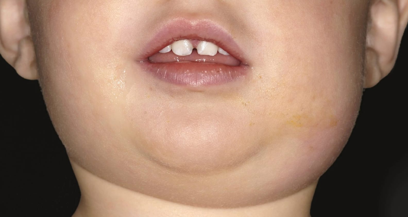 Ilustrasi gondongan pada anak.