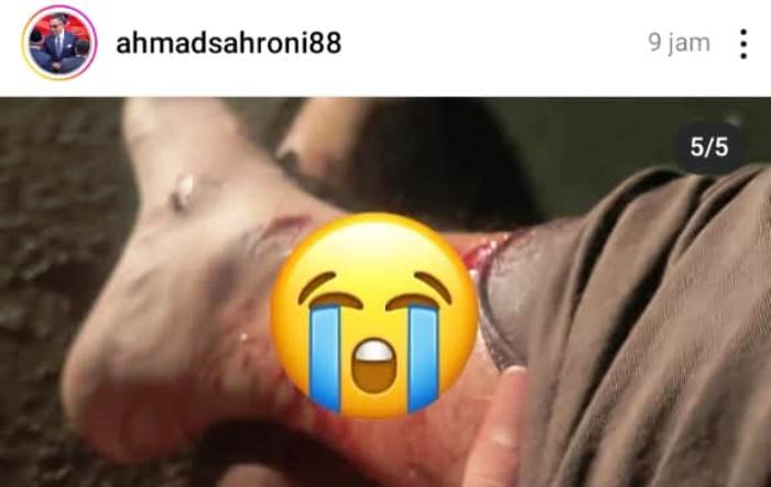 Unggahan di akun Instagram Ahmad Sahroni tentang suami yang patah kaki akibat terseret mobil istrinya usai memergoki sang istri selingkuh.