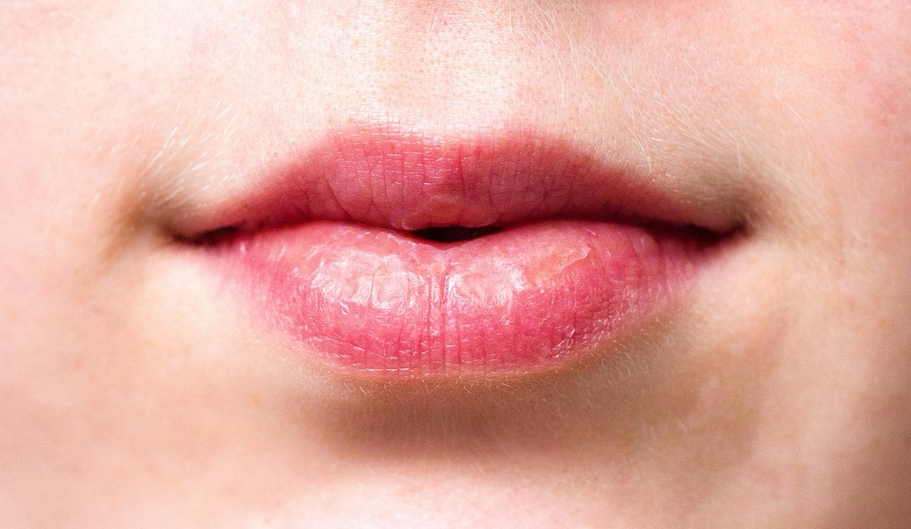 Ilustrasi kondisi bibir kering.