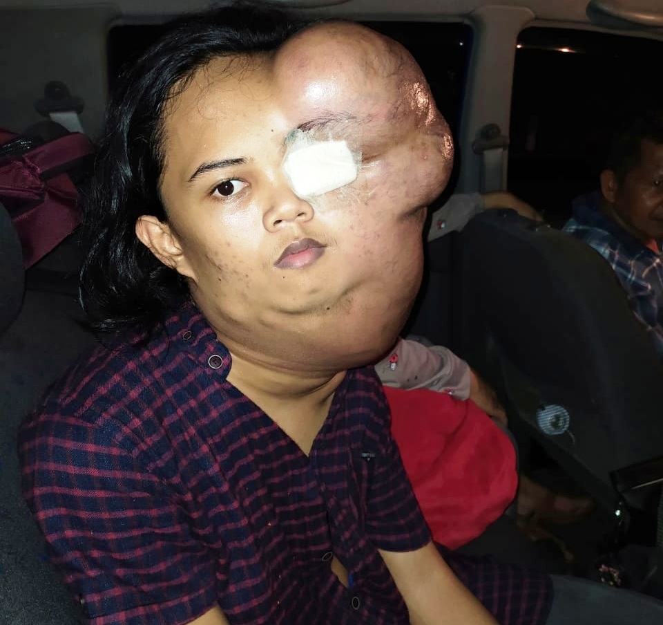 Saldi Ramadhan (20), putra Gasan Gadang, Padangpariaman butuh uluran tangan dermawan.