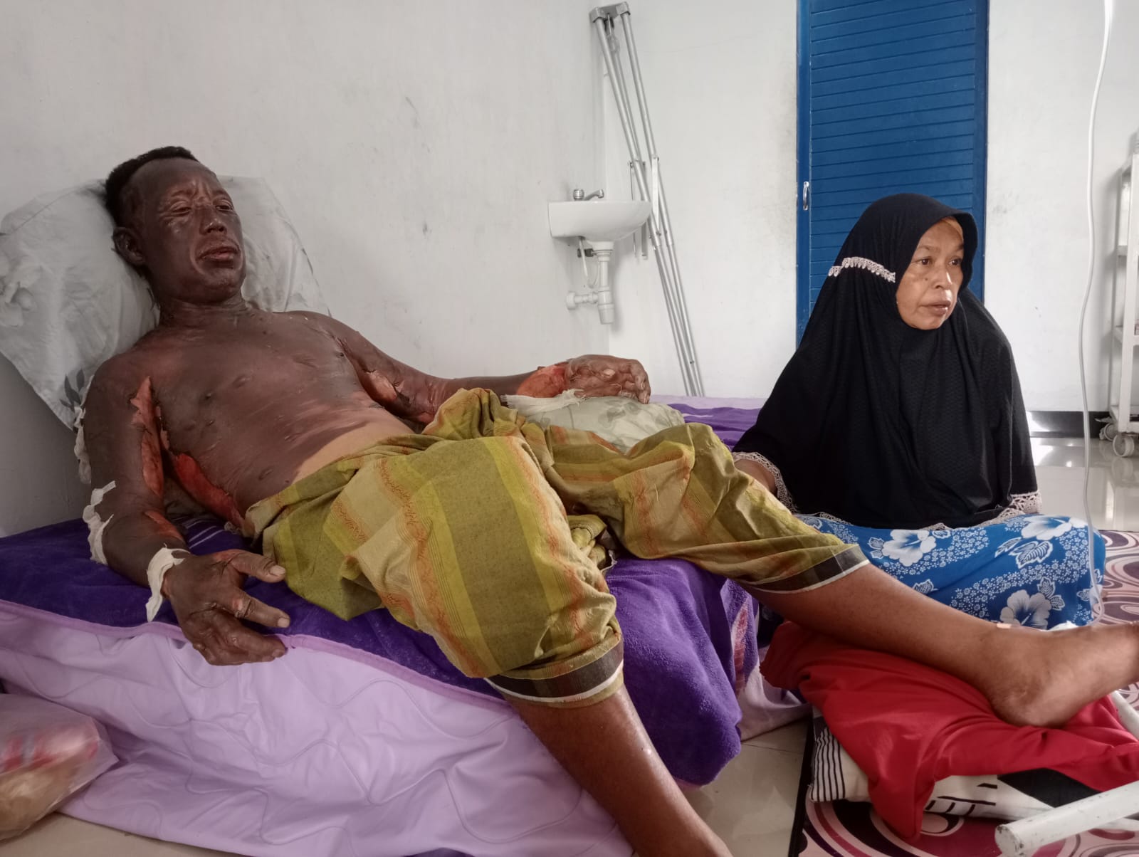 DIRAWAT: Didampingi istrinya, Aswar  mendapat perawatan dengan luka bakar disekujur&nbsp;tubuhnya.