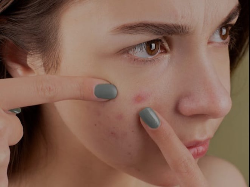 Ilustrasi, jerawat bisa hadir di wajah oleh beberapa makanan ada beberapa mitos yang tercipta karenanya. (pexels.com)