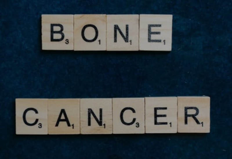 ilustrasi, kanker tulang adalah salah satu jenis kanker yang jarang terdeteksi dini. (pexels.com)