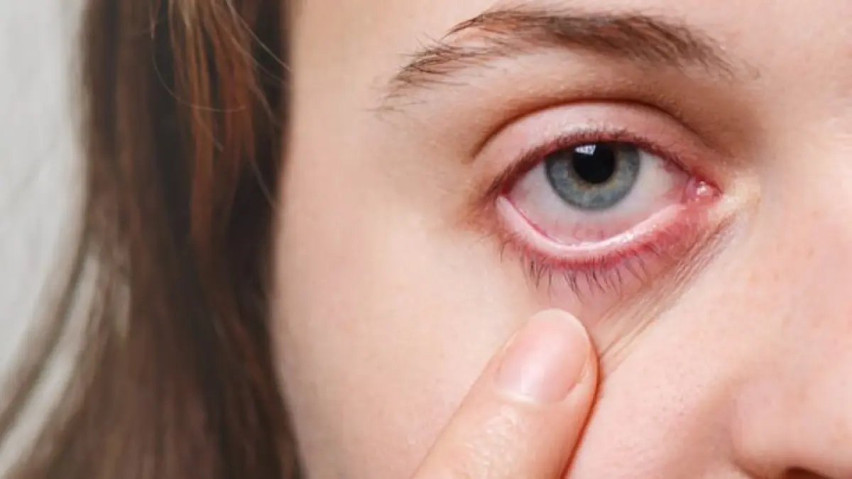 ilustrasi, stroke mata terjadi karena ada penyumbatan pembuluh darah pada retina.(pexels.com)