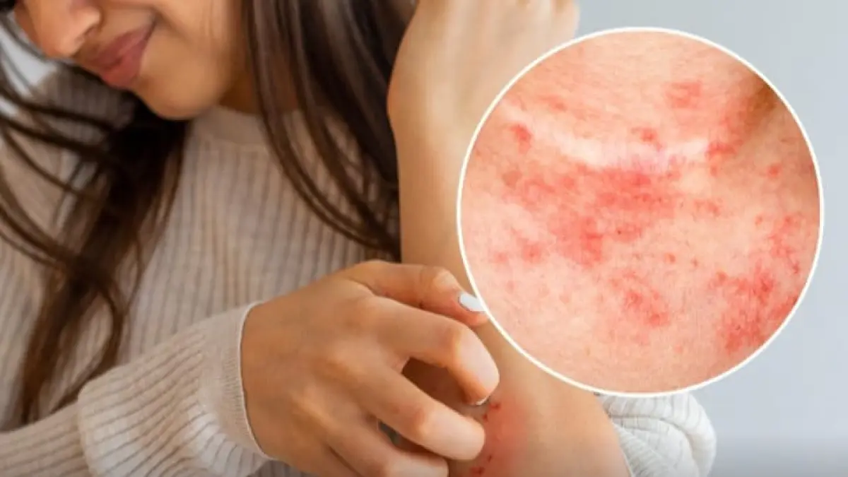 Peringatan World Atopic Eczema Day.(Instagram @pandemictalks)