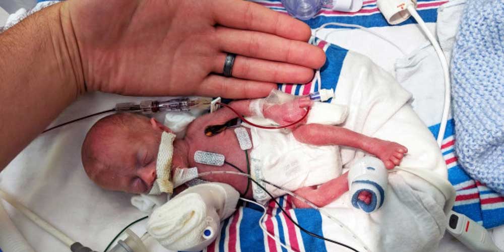 BAYI PREMATUR: Seorang bayi prematur dalam perawatan intensif.