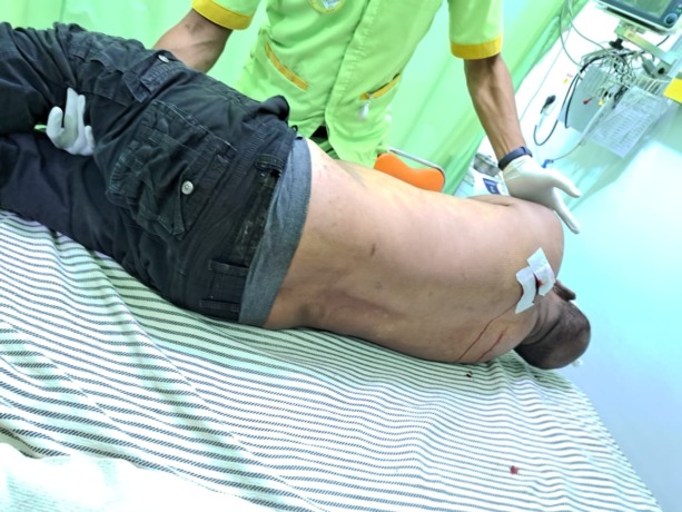 DITIKAM: Korban ditikam di punggung belakang sebelah kiri dibawa ke rumah sakit. (IST)
