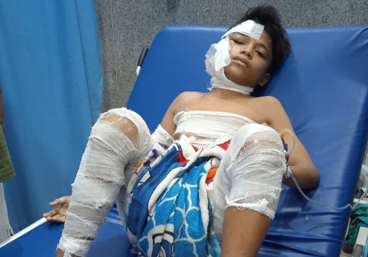 BAKAR: Agung Ibrahim (13) menjadi korban pembakaran pipa Penyaluran BBM milik Pertamina di Jalan Pulau Sinabang, Keluarahan Belawan Bahari saat dirawat di rumah sakit.