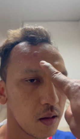 LUKA: Kapten tim PSMS Rachmad Hidayat luka dikepala akibat dipukul Wakil Presiden Persiraja. (IST)