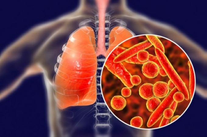 Ilustrasi Mycoplasma Pneumonia.