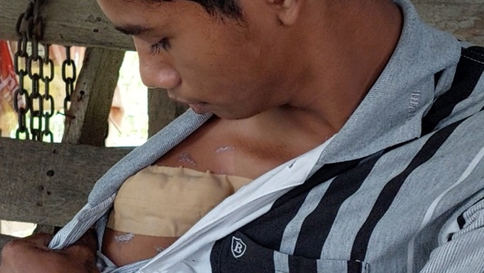 DIRAWAT: Korban Anjas yang mengalami luka di bahu dan harus mendapat perawatan medis sebanyak 25 jahitan.Istimewa/Sumut Pos.