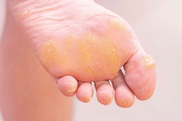 Ilustrasi. Kaki kapalan bisa diobati. Salah satunya menggunakan batu apung alami.