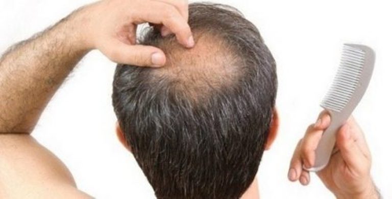 Rambut rontok atau kebotokan tidak sepenuhnya dikarenakan banyak konsumsi makanan mengandung mecin.