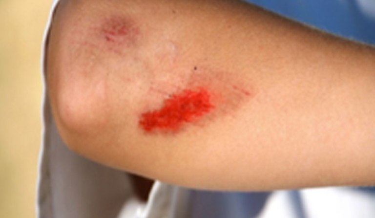 ILUSTRASI. Luka gores atau luka lecet di lengan.