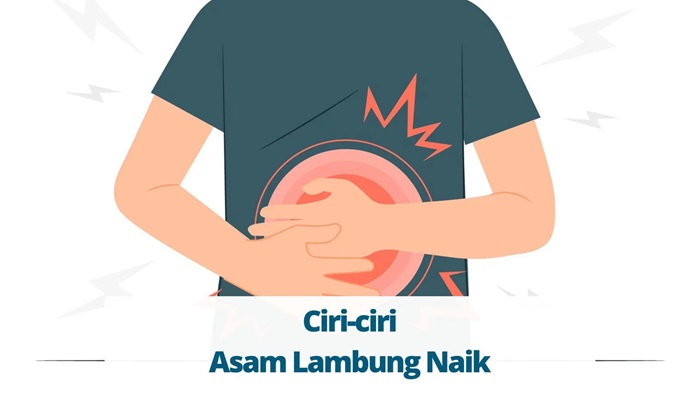 ILUSTRASI. Ciri-ciri asam lambung naik.