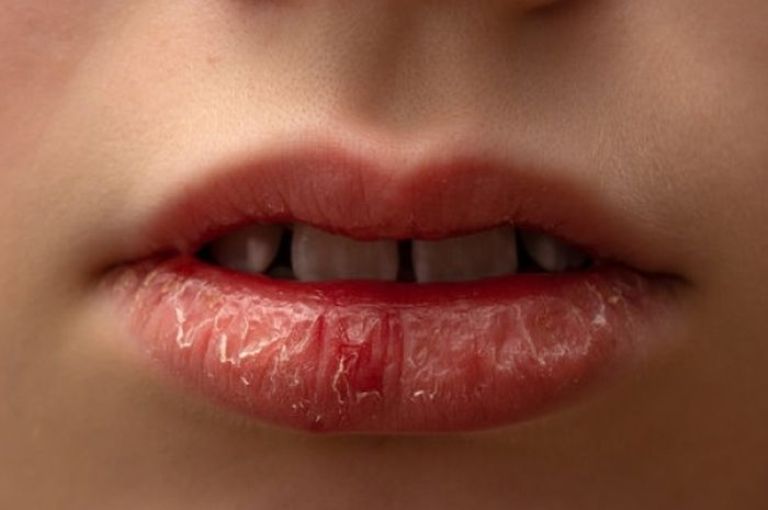 ILUSTRASI. Bibir kering dan pecah-pecah.