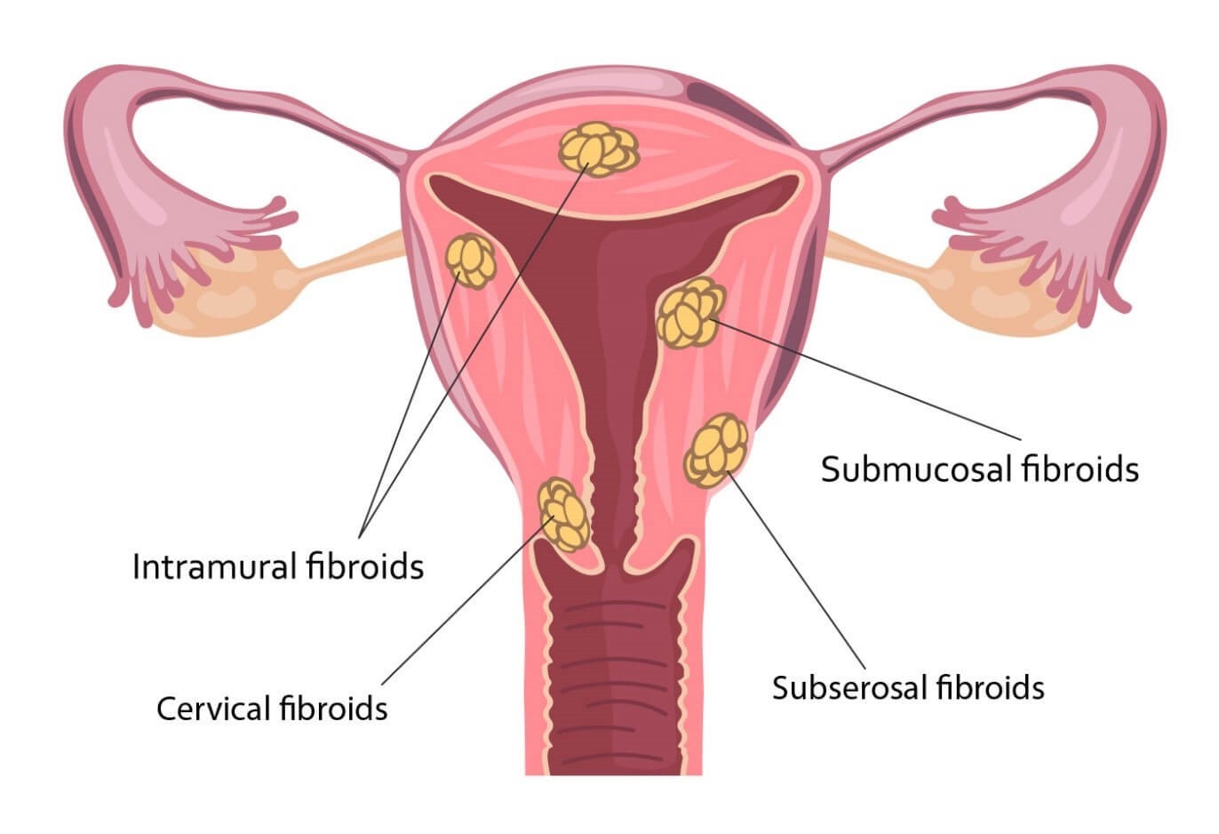 ILUSTRASI tata letak miom dalam rahim wanita.