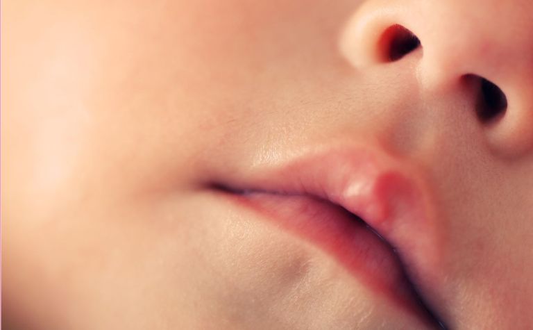 ILUSTRASI. Bibir balita tampak kering.