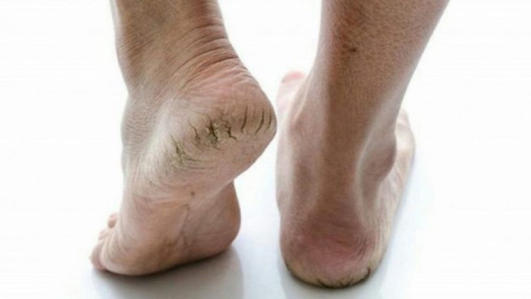 ILUSTRASI. Kulit kaki pecah-pecah perlu perawatan rutin.