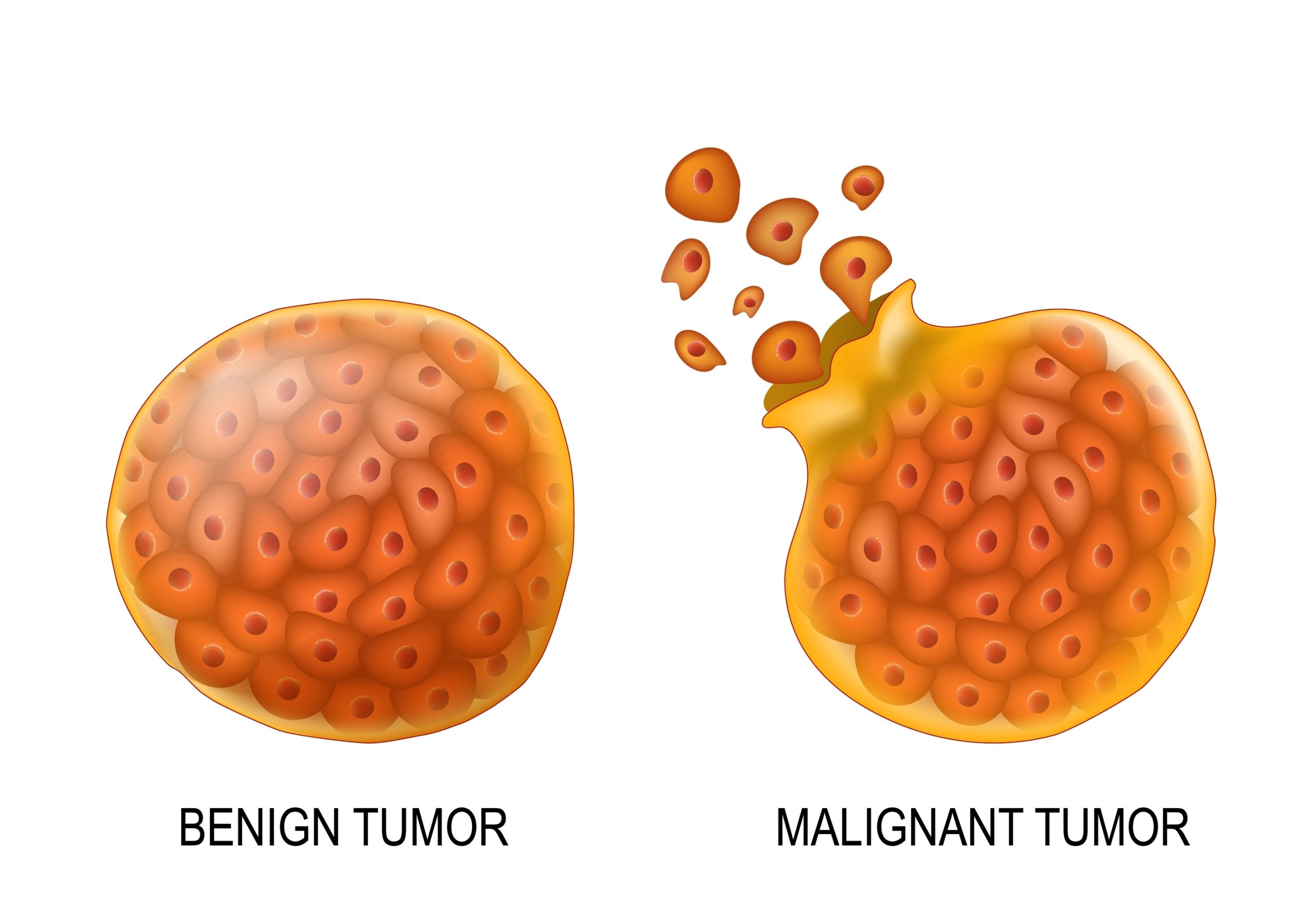 ILUSTRASI tumor jinak vs tumor ganas.