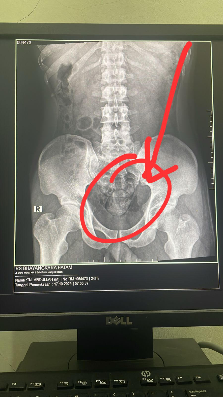 Hasil  rontgen di RS Bhayangkaya menunjukkan narkoba di simpan lewat dubur tersangka.