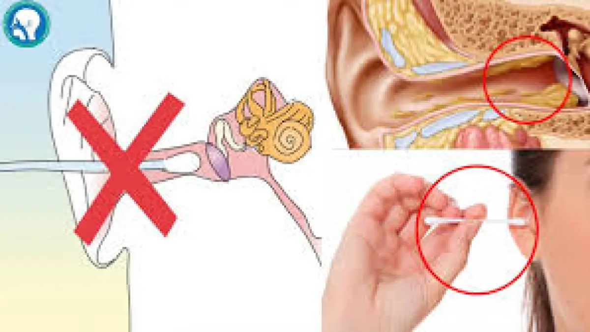 ILUSTRASI membersihkan telinga dengan cotton bud yang dianggap berbahaya secara medis. F Balaji Ear and Hearing Aid Center