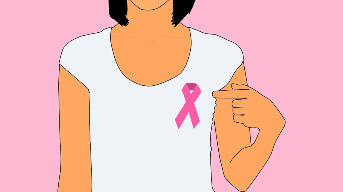 Ilustrasi kanker payudara.