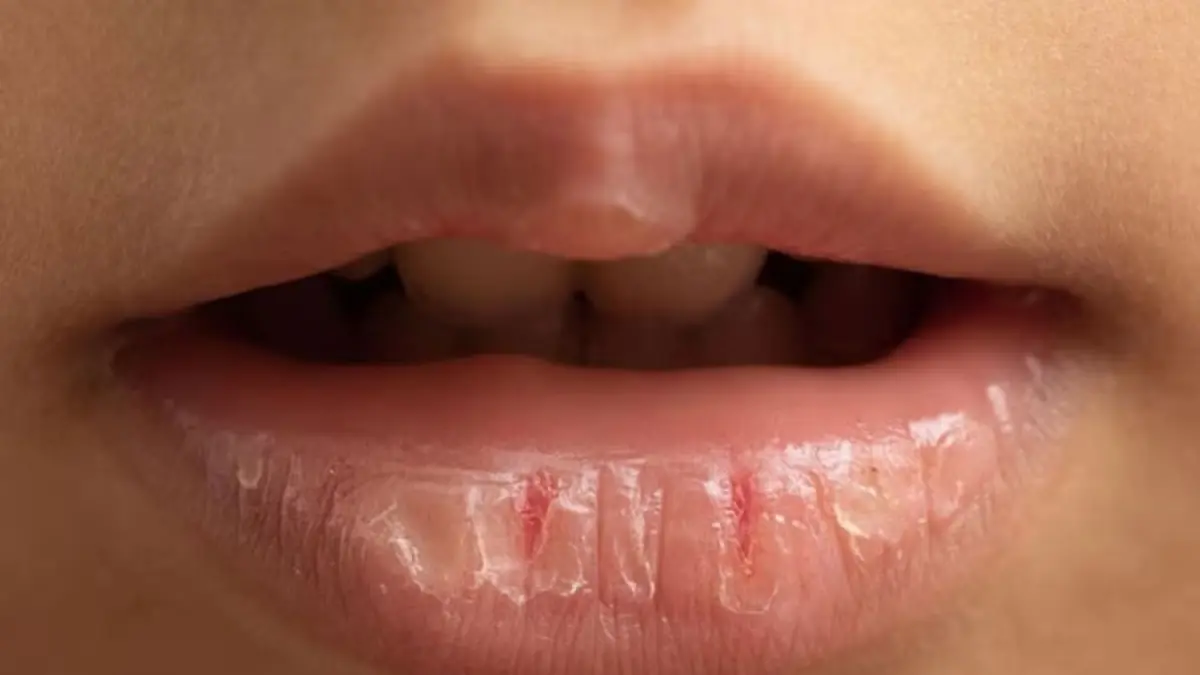 ilustrasi bibir kering dan pecah-pecah. Sumber foto: Freepik