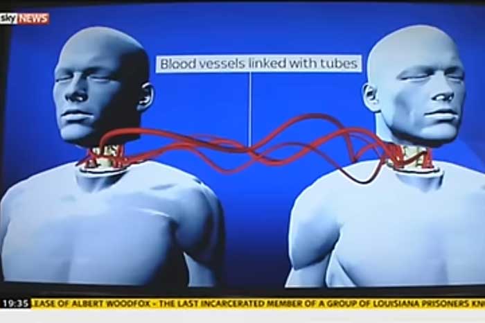EKSPERIMEN MEDIS: Ilustrasi skenario transplantasi kepala.