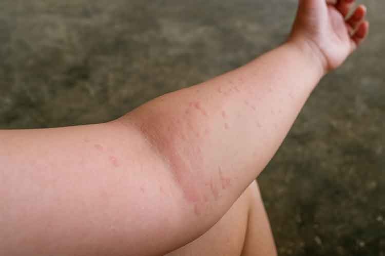 Ilustrasi kulit kena biduran atau alergi dingin. (Gambar diolah dengan akal imitasi)