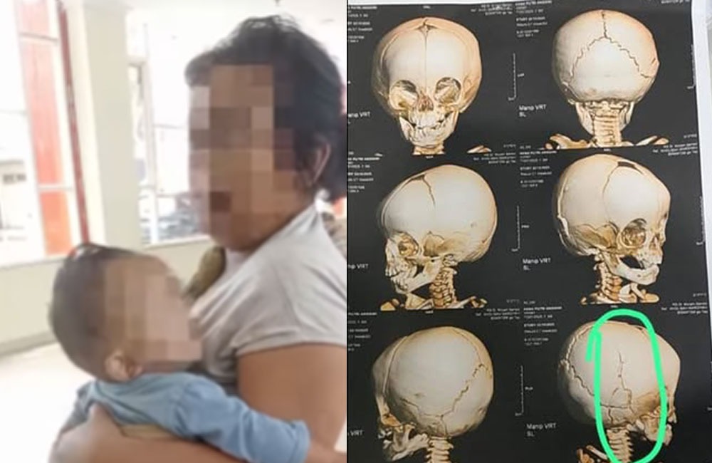 Bayi yang jadi korban amukan ODGJ saat digendong ibunya di RSUD dr Murjani Sampit, tampak juga hasil rontgen tengkorak yang mengalami keretakan.