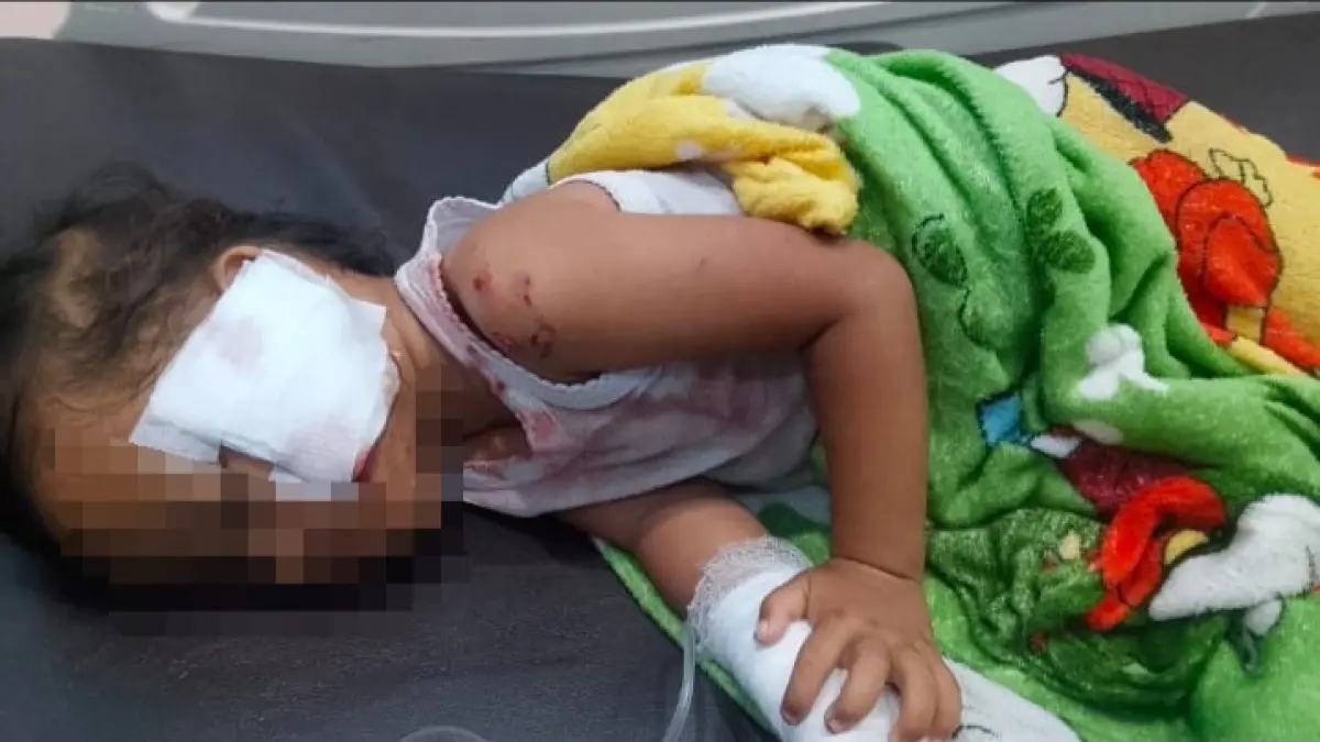 LUKA PARAH: DRN (3) balita di Desa Karang Mulya setelah mendapat pertolongan pertama dari Puskesmas, korban harus dirujuk ke RSUD Sultan Imanuddin untuk penanganan lebih lanjut. (warga/radar sampit)
