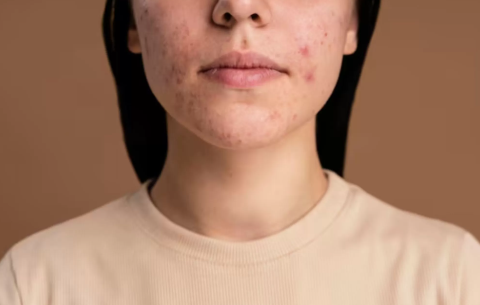 Foto setengah wajah perempuan dengan jerawat (Dok. Freepik)