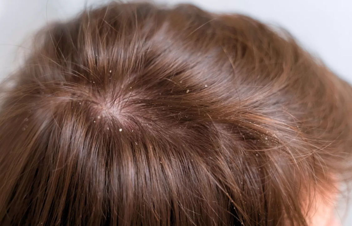 Ilustrasi kulit kepala. (Freepik)