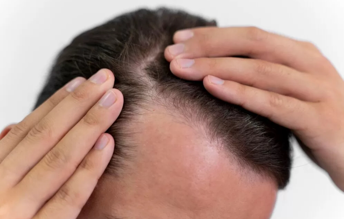 Ilustrasi rambut rontok. (freepik)