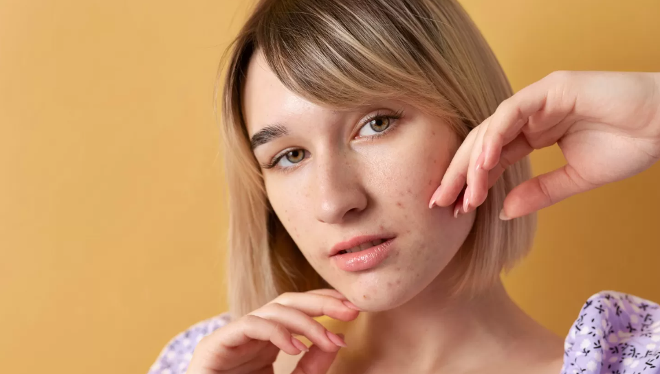 ilustrasi kulit berjerawat (Freepik/Freepik)